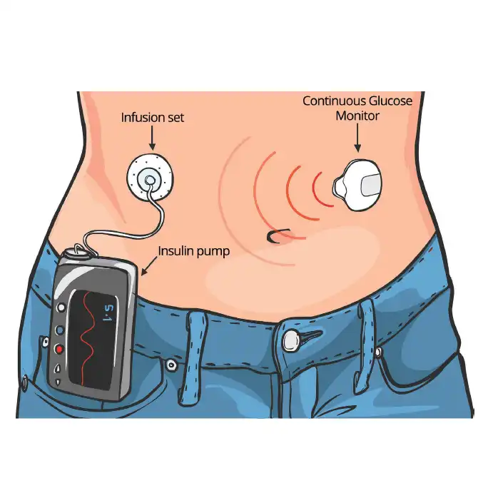 Insulin Pump